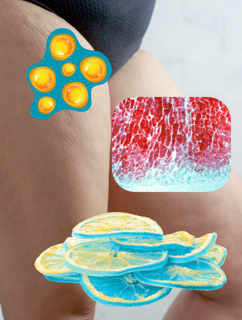 lipodoeme