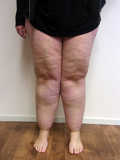 Lire la suite à propos de l’article Tout savoir sur le lipoedème
